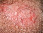 Psoriasis on Penile Skin