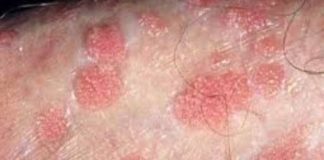 Eczema on Penis Picture