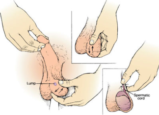 Lump on Testicles Picture