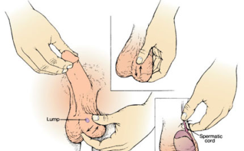 Lump on Testicles Picture