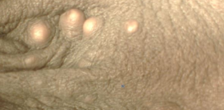 White Dots on Testicles Sac Picture