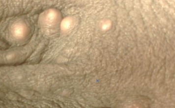 White Dots on Testicles Sac Picture