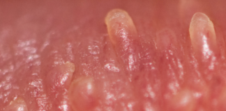 Pearly Penile Papules Removal