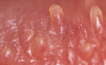 Pearly Penile Papules Removal