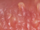 Pearly Penile Papules Removal