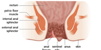 Sharp pain in anus could be Anal Fissures