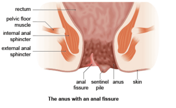 Sharp pain in anus could be Anal Fissures