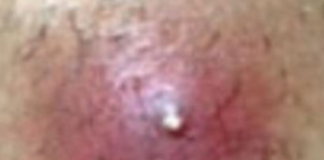 Infected Ingrown Hair