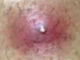 Infected Ingrown Hair