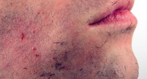 Ingrown Facial Hair Picture