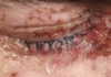 Shingles in Eye Symptoms