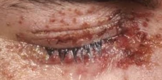 Shingles in Eye Symptoms