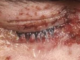 Shingles in Eye Symptoms