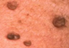 Skin tags on Penis Picture