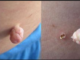 How to get rid of skin tags