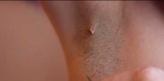 Ingrown Armpit Hair Picture