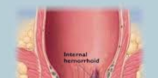 Lumps on Anus - Hemorrhoids