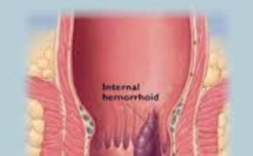 Lumps on Anus - Hemorrhoids