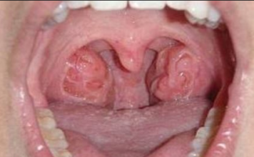 Holes in Tonsils