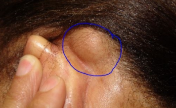 Lump behind Ear